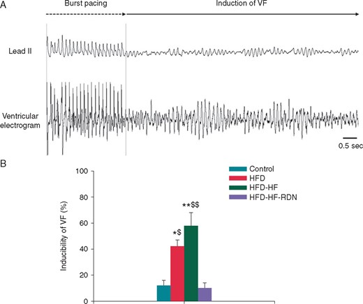 Incidence of VF by burst ventricular pacing. (A) A representative example of VF induction. In this model, 1:1 cycle length of a shortest ventricular pacing was 140 ms. VF was induced during a ventricular burst pacing at 1:1 cycle length of 140 ms in a HFD-HF rabbit. (B) Inducibility of VF among the four groups. HF, heart failure; HFD, high-fat diet; RDN, renal denervation; VF, ventricular fibrillation. *P<0.05 vs. Control, **P<0.01 vs. Control, $P < 0.05 vs. HFD-HF-RDN and $$P < 0.01 vs. HFD-HF-RDN.