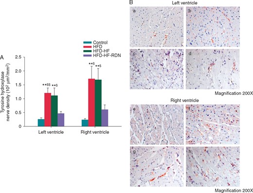 Cardiac sympathetic nerve activities in the ventricle. (A) Sympathetic neuron marker densities among all groups. (B) The example of TH staining. (a) Control rabbits left ventricle; (b) HFD rabbits left ventricle; (c) HFD-HF rabbits left ventricle; (d) HFD-HF-RDN rabbits left ventricle; (e) Control rabbits right ventricle; (f) HFD rabbits right ventricle; (g) HFD-HF rabbits right ventricle; and (h) HFD-HF-RDN rabbits right ventricle. HF, heart failure; HFD, high-fat diet; RDN, renal denervation. **P<0.01 vs. Control, $P < 0.05 vs. HFD-HF-RDN and $$P<0.01 vs. HFD-HF-RDN.