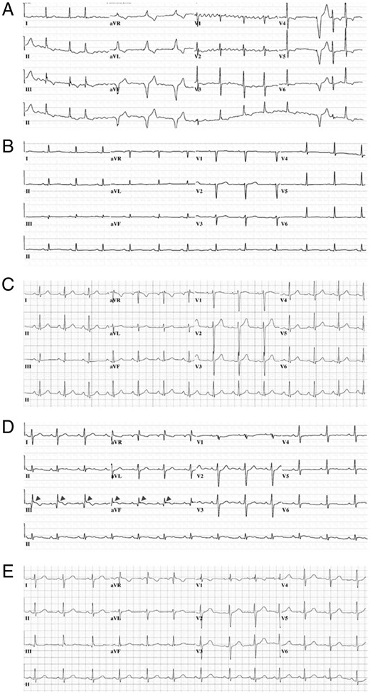 Baseline 12-lead ECGs obtained during the referral evaluation of SCN5A ultra rare variant-positive unexplained SCA survivors. (A) Representative 12-lead ECG from p.Glu30Gly-SCN5A-positive unexplained SCA survivor. (B) Representative 12-lead ECG from p.Gln245Lys-SCN5A-positive unexplained SCA survivor. (C) Representative 12-lead ECG from p.Pro648Leu-SCN5A-positive unexplained SCA survivor. (D) Representative 12-lead ECG from p.Asp872Asn-SCN5A-positive unexplained SCA survivor. (E) Representative 12-lead ECG from p.Glu1240Gln-SCN5A-positive unexplained SCA survivor. ECG, electrocardiogram; SCA, sudden cardiac arrest.