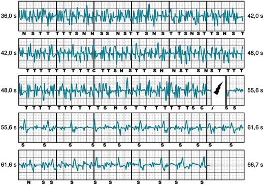 Inappropriate shock due to myopotentials/noise. Representative example of IAS caused by myopotentials/noise. , shock delivered; C, capacitor charging start/end; IAS, inappropriate shocks; N, noise; T, tachy detection.