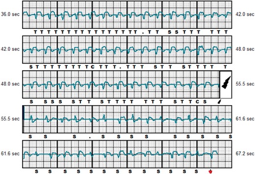 Inappropriate shock caused by TWOS. Representative example of IAS caused by TWOS during slow ventricular tachycardia of 155 b.p.m. , shock delivered; C, capacitor charging start/end; IAS, inappropriate shocks; S, QRS sensing; T, tachy detection; TWOS, T-wave oversensing.