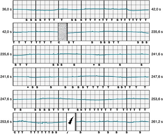 Inappropriate shock caused by under-sensing. Representative example of IAS shock caused by under-sensing, 8 h after successful implantation of the S-ICD. , shock delivered; C, capacitor charging start/end; IAS, inappropriate shocks; S, QRS sensing; S-ICD, subcutaneous implantable cardioverter-defibrillator; T, tachy detection.