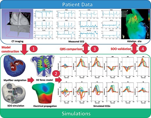 Scheme of the proposed methodology: (1) patient-specific geometries were created from medical CT scans. Cardiomyocyte orientation was assigned using the OT-RBM algorithm14; (2) electrophysiological simulations were run from different SOO and ECGs were calculated after the propagation to the torso surface; (3) simulated ECGs were compared with the patient ECG in order to find the most similar pattern and therefore the best candidate for the SOO; (4) suggested SOO were then validated against the ablation site. AV, aortic valve; CT, computed tomography; ECG, electrocardiogram; LCC, left coronary cusp; NCC, non-coronary cusp; PV, pulmonary valve; RCC, right coronary cusp; SOO, sites of origin.
