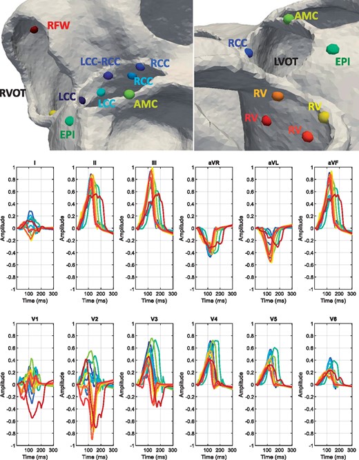 Top row: spheres show the 12 different locations used as SOO in the simulations on a patient geometry. Seven were LV-SOO (bluish and greenish colours): two in the LCC and two in the RCC (LCC and RCC, respectively), one in the LCC-RCC commissure, one in the AMC and one in the LV summit (at the epicardium, EPI). The five RV-SOO were distributed as follows: four in the septal side of the RV, including two close (orange and yellow colours) and two distant (red colours) from the pulmonary valve, as well as one in the free-wall (RFW). Second and third rows: simulated 12-lead electrocardiogram. Each signal colour matches with the colour of the point that represents the SOO. AMC, aorto-mitral continuity; EPI, epicardium; LCC, left coronary cusp; LVOT, left ventricular outflow tract; RCC, right coronary cusp; RFW, right-sided free wall; RV, right ventricle; RVOT, right ventricular outflow tract; SOO, site of origin.