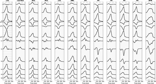 Twelve-lead simulated signals for the 12 different sites of origin of Patient 11. AMC, aorto-mitral continuity; EPI, epicardium; LCC, left coronary cusp; RCC, right coronary cusp; RFW, right-sided free wall; RV, right ventricle.