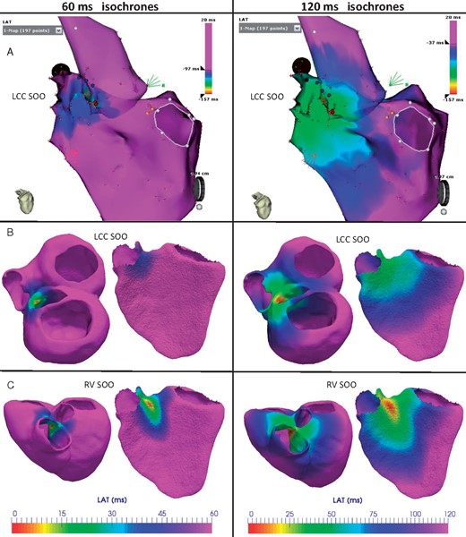 Comparison of measured and simulated LAT isochrones in Patient 2, who had a clinical LV-SOO with a successful ablation on the LCC. Red and pink colours indicate the earliest and the latest activated regions, respectively. First and second columns show the isochrones 60 ms and 120 ms after the trigger, respectively. (A) LATs measured with the electroanatomical map system during the ablation intervention. (B and C) Isochronal maps from electrophysiological simulations with a LCC and a RV-SOO, respectively. The simulated electrical patterns with a LV SOO (B) are more similar to the ones seen in the acquired data (A) than with a simulated RV SOO (C). LAT, local activation time; LCC, left coronary cusp; LV-SOO, left ventricle site or origin; RV-SOO, right ventricle site or origin; SOO, site of origin.