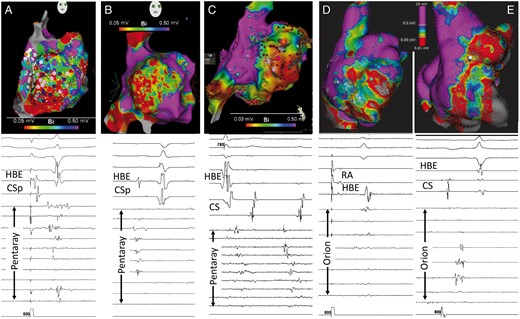 Electroanatomic mapping of the right atrium. The upper panels present the right lateral voltage map for each of the five patients. Voltage range is from 0.03/0.05 mV to 0.5 mV. Note that all five maps demonstrate an extensive LVZ occupying virtually the entire RA free wall from the crista terminalis posteriorly to the tricuspid annulus anteriorly. Superiorly the LVZ reaches the superior RA and inferiorly merges with the inferior vena cava. The purple and pink dots in the left most panel indicate sites of complex electrograms and the red dots in the middle panel indicate ablation points. The lower panels show representative electrogram examples from within the LVZ using either the pentaray (A–C panels) or the orion (D and E panels) mapping catheters. Recordings are made during sinus rhythm or atrial pacing with the exception of the middle panel (C), which demonstrates electrograms during an unstable atrial arrhythmia. Note the low amplitude, multi-component complex electrograms. There are also some channels with no recordable near field electrograms despite adequate tissue contact indicating regions of scarring. LVZ, low-voltage zone; HBE, His bundle electrogram; CS, coronary sinus; RA, right atrium.