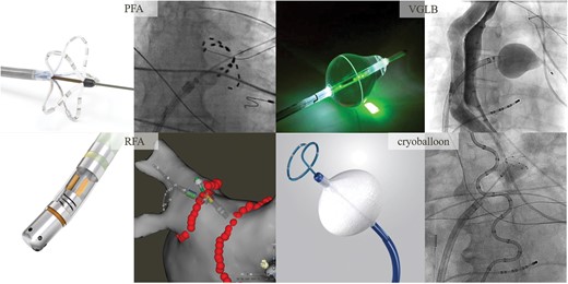 Catheter ablation technologies. PFA: The multispline PFA catheter is positioned at the ostia of each vein to deliver a therapeutic waveform. RFA: Point-by-point ablation lesions are delivered to achieve circumferential PVI. VGLB: Under endoscopic visual guidance, ablation lesions are delivered in a circumferential, contiguous, and overlapping manner around the vein. Cryoballoon: With the balloon apposed against the ostia of each vein, cryoapplications are delivered. PFA, pulsed field ablation; RFA, radiofrequency ablation; VGLB, visually guided laser balloon.
