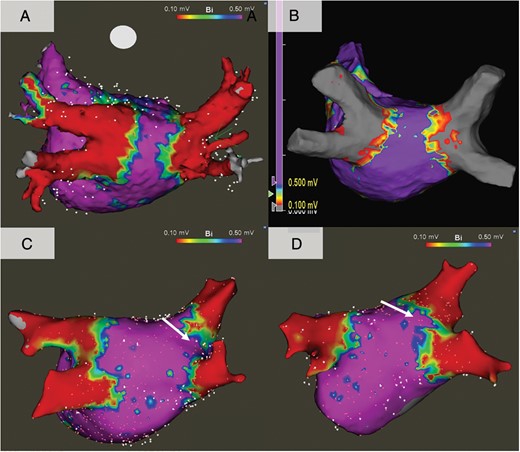 Representative voltage maps. (A) Pulsed field ablation, (B) radiofrequency ablation, (C) cryoballoon ablation, and (D) visually guided laser balloon. In the balloon sub-cohorts, there were notch-like areas of normal voltage at the carinal areas (white arrows).