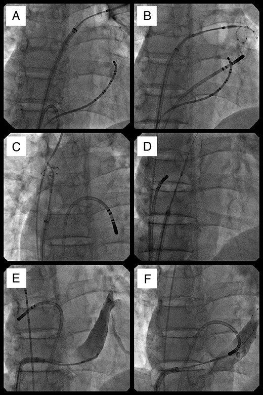 Radiographic images of the simultaneous use of a cryoballoon and a focal cryotherapy catheter. Al views are in an anteroposterior projection. Starting before transseptal puncture and continuing during treatment of the right superior vein, a focal catheter was used to ablate the cavotricuspid isthmus (A). It was moved to the coronary sinus during cryoballoon treatment of the left inferior pulmonary vein (B), then to the inter-atrial septum as the balloon treated the ostium of the superior vena cava (C), and the right atrial aspect of the inter-atrial septum (D). It was moved back to the left atrium as the balloon was used to treat the ostium of the coronary sinus (E).