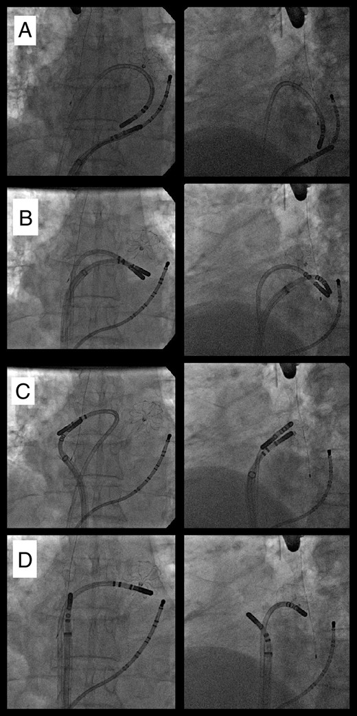 Radiographic images of the simultaneous use of two focal cryocatheters. Viewed in an anteroposterior projection (left panels) and a left anterior oblique projection (right panels) a patient with closure device in the left atrial appendage has had the pulmonary veins isolated. After removal of the balloon, one focal catheter was used to treat the epicardial myocardium through the coronary sinus as other was used to create an endocardial coronary sinus line (A). Both catheters were than used together to treat the mitral isthmus (B) then the left atrial roof (C), then used separately to treat areas of fractionation (D).