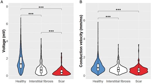 Voltage and conduction velocity distribution. Distribution of the local bipolar voltage (A) and the local CV (B) in the three different regions identified in the LGE-MRI. ***P < 0.001. CV, conduction velocity; LGE-MRI, late gadolinium enhanced-magnetic resonance imaging.