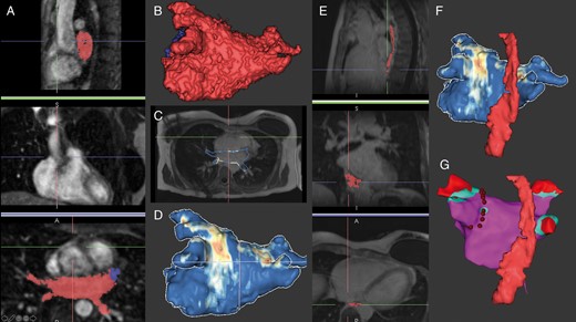 The process of MR image segmentation using ADAS 3D software (ADAS3D Medical) for integration during AF ablation. (A) Sagittal, coronal, and axial MR angiography images with semi-automatic segmentation of the left atrium using an intensity threshold (red mask: left atrium, blue mask: LAA) and resulting in the left atrial segmentation in (B). In (C), the contour is applied to the LGE image and normalized intensity measurements of the left atrial myocardium are colour coded to produce the anatomic and scar model segmentation in (D). (E) Manual oesophageal segmentation in sagittal, coronal, and axial planes resulting in the three-dimensional model in (F). Ultimately, the segmented model is imported into the electroanatomic mapping system and registered to procedural coordinates from ultrasound or fast anatomic mapping chamber boundaries. In (G), the left atrial voltage map shows healthy tissue in purple, voltage <0.2 mV in blue, <0.1 mV in red, radiofrequency lesions surrounding the left sided pulmonary veins as red dots, and the oesophagus anatomy as registered from the MR image. LAA, left atrial appendage, LGE, late gadolinium enhancement; MR, magnetic resonance.