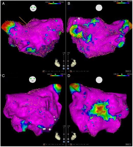 Anterior (A) and posterior (B) views of a left atrial map of a patient with no OSA (AHI 4.3). Minimal low-voltage regions observed. Anterior (C) and posterior (D) views of a left atrial map of patient with severe OSA (AHI 41.6) shows a circumscribed well delineated region of low voltage on the posterior wall. Note that the remainder of the atrium has normal voltage. AHI, apnoea–hypopnoea index; OSA, obstructive sleep apnoea.