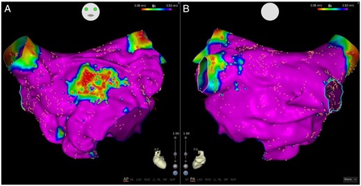 Anterior (A) and posterior (B) views of a left atrial voltage map in a patient with paroxysmal AF with severe OSA (AHI 32) shows a well demarked region of low voltage on the anterior wall with preserved voltage elsewhere. AF, atrial fibrillation; AHI, apnoea–hypopnoea index; OSA, obstructive sleep apnoea.