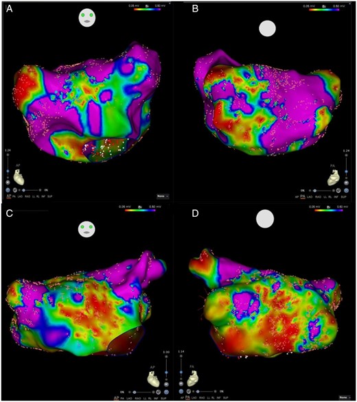 Comparison of left atrial voltages in patients with persistent AF. Anterior (A) and Posterior (B) views of a left atrial map of a patient with no-mild OSA (AHI 7.4). Anterior (C) and Posterior (D) views of a left atrial map of patient with severe OSA (AHI 61.7). Both maps show diffuse substrate with low voltage distributed among most atrial segments. AF, atrial fibrillation; AHI, apnoea–hypopnoea index; OSA.
