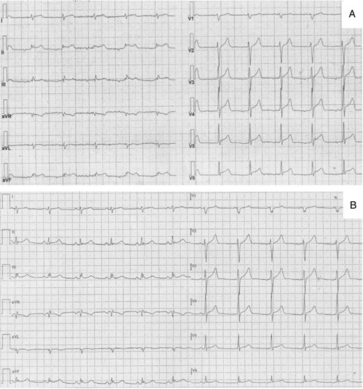 Electrocardiograms during (A) and after resolution (B) of chest pain in Patient #6. In (A) a ST-segment elevation in infero-lateral leads is present which returns to normal after cessation of chest pain (B).