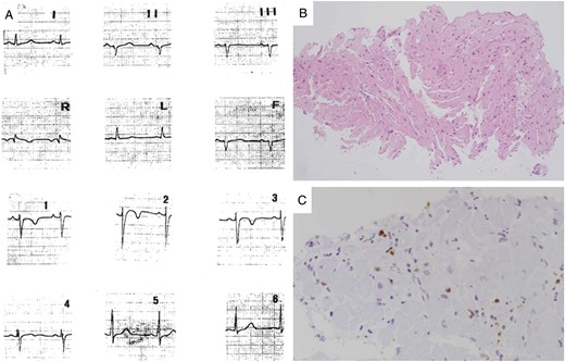 A 12-year-old patient (Patient #7) with chest pain at disease onset. Twelve-lead ECG performed at the time of chest pain episode (A): note the mild ST-segment elevation in V1–V3 with T-wave inversion. Endomyocardial biopsy reveals diffuse interstitial oedema and focal inflammatory cell infiltrates (B, haematoxylin–eosin stain), which are positive for activate T-lymphocytes (C, CD3 immunohistochemistry). ECG, electrocardiogram.