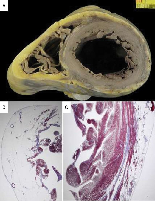 Sudden death in AC 30 years after his clinical presentation with chest pain (same patient as in Figure 3). At autopsy, the heart in cross section reveals diffuse biventricular involvement (A) with transmural fibro-fatty replacement of the RV free wall (B, trichrome staining ×3) and sub-epicardial mid-mural involvement of the LV free wall (C, trichrome staining ×3). AC, arrhythmogenic cardiomyopathy; LV, left ventricle; RV, right ventricle.