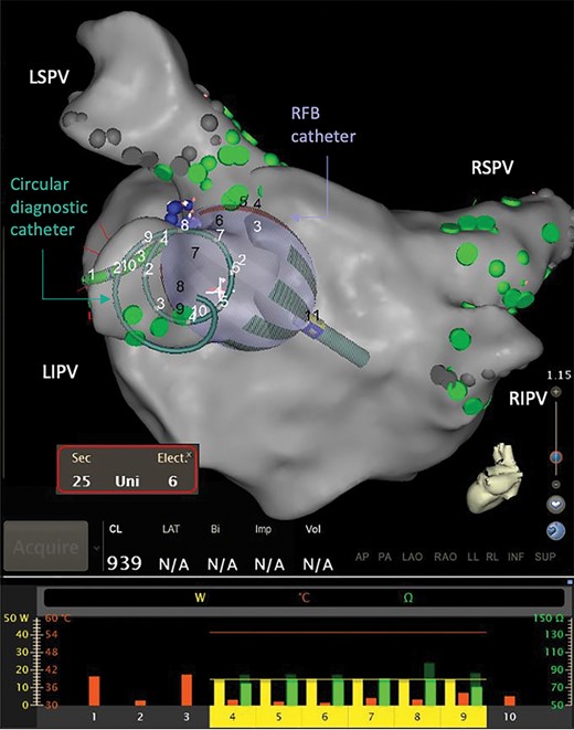 The RFB and circular diagnostic catheter as visualised using the electroanatomical mapping system. The RFB and the circular diagnostic catheter are shown at the ostium of LIPV during ablation, where the bottom panel reflects the RF power being delivered (yellow bar, 0–40 W), temperature measured (orange bar, 0–60 Celsius), starting impedance (dark green, 0–150 Ohms), and current impedance (bright green, 0–150 Ohms) for each of the 10 individual electrodes. The bottom panel also shows the posterior electrodes #1–#3 are turned off. LIPV, left inferior pulmonary vein; LSPV, left superior pulmonary vein; RF, radiofrequency; RFB, radiofrequency balloon catheter; RIPV, right inferior pulmonary vein; RSPV, right superior pulmonary vein.