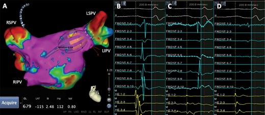 (A) Voltage map of the left atrium and electrogram recorded by the circular diagnostic catheter (B) before, (C) during, and (D) after LSPV isolation with the RFB. LSPV, left superior pulmonary vein; RFB, radiofrequency balloon; RIPV, right inferior pulmonary vein; RSPV, right superior pulmonary vein.