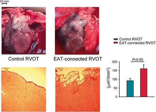 Pictures illustrate RVOT with and without connection to the adipose tissue. The selected area marked by dash line are examples of RVOT with (EAT-connected RVOT) and without connected EAT (control RVOT). Fibrotic remodelling of the subepicardium in RVOT samples with (right lower) or without EAT (left lower). The extent of fibrotic was assessed on Sirius Red stained sections. Bar figure represent subepicardial fibrosis (portions of fibrosis area/epicardial tissue) in EAT-connected (N = 6) and control (N = 5) RVOT specimens. *P < 0.05. EAT, epicardial adipose tissue; RVOT, right ventricular outflow tract.