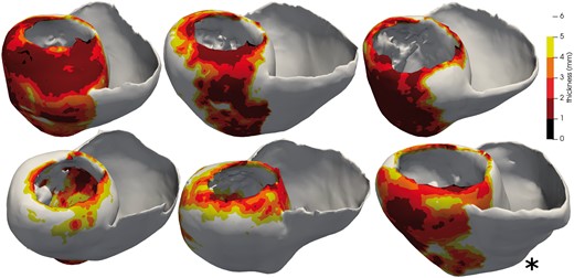 Five cardiac anatomies from CT imaging used for training and one (*) for testing. The thickness maps show the infarct scars.