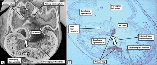 The images show, to the left hand, an episcopic dataset (A), and to the right hand a histological section prepared to react to an antibody derived from the nodose ganglion of the chick (B). The heart used to prepare the episcopic dataset was graded as representing Carnegie stage 14, whereas the heart from which the section was made was graded at Carnegie stage 13. They are showing the same basic stage of development, which represents ∼34 days subsequent to fertilization. The antibody to the nodose ganglion has marked the cardiomyocytes of the primary ring, which encircle the embryonic interventricular communication. At the same time, the cardiomyocytes occupy the rightward margin of the atrioventricular canal (see Figure 3). At this early stage of development, the atrioventricular canal, along with the atrioventricular cushions, is supported exclusively above the cavity of the developing left ventricle.