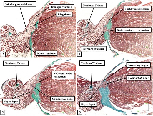 The images, shown in attitudinally appropriate fashion, with the atrial chambers seen to the left of their corresponding ventricles, are from a dataset prepared from a 21 week human foetus. They confirm that the compact atrioventricular node is formed by conjunction of extensions from the tricuspid and mitral vestibules. The axis is insulated as it passes beneath the fibrous continuity between the leaflets of the mitral and tricuspid valves. Note that, in this foetal heart, connections persist between the developing node and the crest of the muscular ventricular septum.