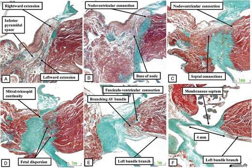 The images show serial histologic sections (panels A through F), again shown in attitudinally appropriate fashion, from a stillborn foetus of 29 weeks of gestation. The make-up of the node is as shown in Figures 8 and 10. In this foetus, however, not only are then extensive nodoventricular connections, as shown in Figure 10, but also fasciculo-ventricular connections (E). At the transition from the node to the penetrating bundle, it is also possible to recognize the feature known as foetal dispersion (D).