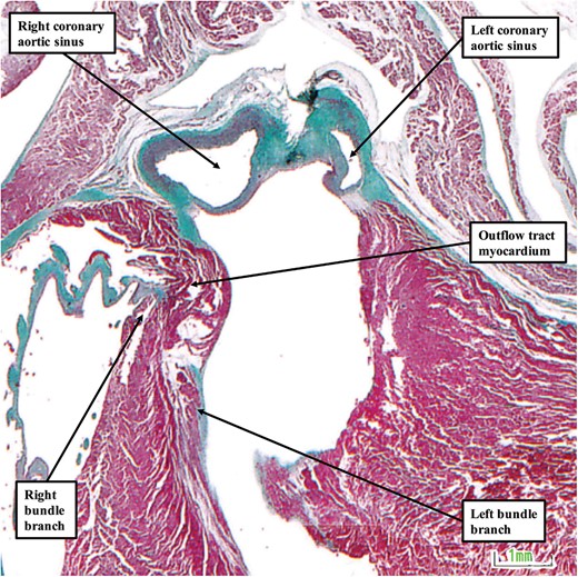 The image shows the relationship between the left bundle branch and the aortic sinuses of the aortic root in a foetus stillborn at 22 weeks of gestation. The image is shown in ‘four chamber’ orientation, with the atrial chambers on top of their respective ventricles. In this heart, there is an extensive collar of outflow tract myocardium that lifts the aortic root away from the base of the heart.