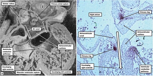 The images show the changes that take place during cardiac development in the human heart as the developing right ventricle achieves its inlet component. The left hand panel (A) is a ‘four chamber’ section through an episcopic dataset of an embryo graded at Carnegie stage 16. The right hand panel (B) is a histological section incubated with the antibody to the nodose ganglion of the chick from another human embryo also graded at Carnegie stage 16. Expansion of the atrioventricular canal has provided the right ventricle with its inlet component, as shown by the white arrow with black borders in (B). As shown in (B), the primary ring now encircles the right atrioventricular junction, occupying the parietal margin of the right atrioventricular canal. The part of the ring on the crest of the newly formed muscular ventricular septum will form the basis of the ventricular conduction pathways.