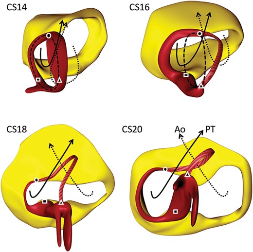 Three-dimensional views on the remodelling of the interventricular foramen. The coding colours are as shown in Figure 3. The dashed black line shows the orientation if the primary ring, itself shown in red, prior to remodelling. It can be divided into three parts. That part between the square and triangle is located on the crest of the developing muscular ventricular septum. The part between the circle and square is incorporated into the right atrioventricular junction, and will expend concomitant with the expansion of the atrioventricular canal. The part between the triangle and circle, which can be considered to represent the aortic ring, will expand leftward along with the formation of the left ventricular outflow tract. Rightward remodelling takes place in the dorsal part of primary ring, while the leftward remodelling takes place in the cranial part. The square identifies the site of the inferior atrioventricular transition. The ring in this area will eventually provide the basis for the formation of the atrioventricular node. The circle marks the superior atrioventricular transition. This part persists as the retro-aortic node, although in some malformations it can persist as a connecting anomalous atrioventricular node. The solid and dotted lines show the changes occurring with the systemic and pulmonary circulations that occur subsequent to the remodelling of the primary foramen. Ao, aorta; CS, Carnegie stage; PT, pulmonary trunk.
