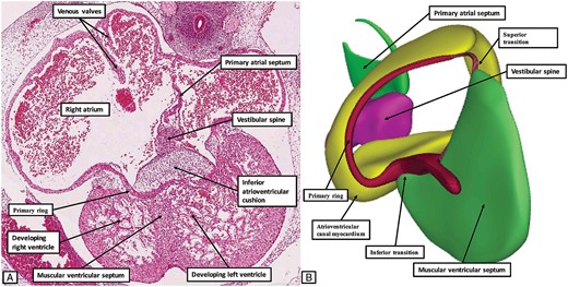 The images show the arrangement of the primary ring at Carnegie stage 17. The left hand panel (A) is a histological section. It shows the inferior transition from the ventricular to the atrial components of the ring. The right hand panel (B), a reconstruction from an embryo at the same stage of development, shows the view of the developing atrioventricular canal from the right ventricular aspect, having removed the atrial and ventricular myocardial walls and the atrioventricular cushions. At this stage, the developing ring is in communication only with the dorsal walls of the developing atrial chambers. The developing base of the atrial septum at this stage is formed by the mesenchymal tissues of the vestibular spine, along with a mesenchymal cap carried on the leading edge of the primary atrial septum.