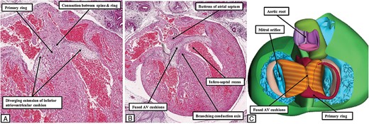 The images show the arrangement of the atrioventricular conduction axis at the end of the embryonic period, ∼8 weeks after fertilization. The left hand panels (A and B) are serial histological sections from a human embryo at Carnegie stage 22. They show how that primary ring emerges between the diverging inferior margins of the fused atrioventricular cushions to make contact with the cardiomyocytes of the newly muscularized inferior buttress of the atrial septum. Panel (C) is a reconstruction of a different human embryo at Carnegie stage 23. The base of the ventricular mass is shown as viewed from the atrial aspect having removed the atrial myocardium. The atrial component of the primary ring can be seen emerging from beneath the atrioventricular cushions, and encircling the orifice of the tricuspid valve. Note that the aortic root, although now in direct communication with the cavity of the left ventricle, remains positioned above the cavity of the right ventricle. Its developing leaflets are separated at this stage from the developing leaflets of the mitral valve by the atrioventricular canal myocardium, which will eventually be converted into the area of aortic-to-mitral fibrous continuity.