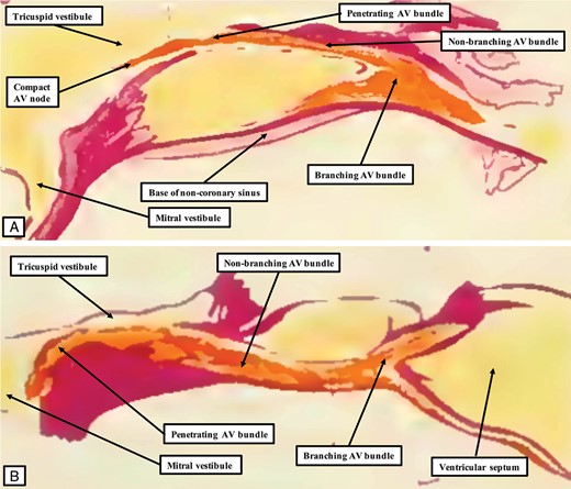 The illustrations are taken from the monograph of Sunao Tawara.1 They have been reorientated to match the majority of the illustrations to be included in our review showing the arrangement of the conduction axis in various animal species. The atrial chambers are seen to the left hand, with the right-sided cavities uppermost. The figures provided by Tawara show the markedly different arrangement of the axis in the dog heart (A) compared with man (B). Our own findings endorse the significance of the differences shown by Tawara.15