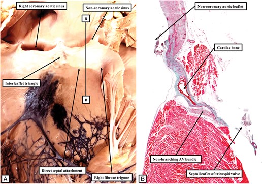The left hand panel (A) shows the aortic root in the bovine heart, with Indian ink injected into the sheaths of the conduction axis so as to reveal the ramifications of the left bundle branch, seen in blue-black. As in the canine and porcine hearts (Figure 7A and 9A), the half of the non-coronary leaflet of the aortic valve adjacent to the right coronary aortic leaflet is attached directly to the septal surface, along with the right fibrous trigone. Note that the left bundle branch emerges from the ventricular septum at a distance from its crest. The line B–B in (A) shows the level and orientation of the histological section shown in (B). The non-branching bundle has a long course, skirting the attachment of the non-coronary leaflet to the septum, and paralleling the arrangement found in the canine heart (Figure 1A).