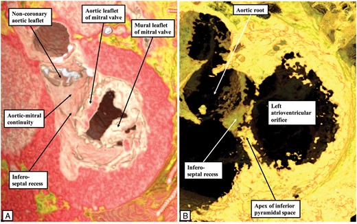 These virtual dissections made using a living dataset prepared from an individual undergoing computed tomographic investigation reveal how the apex of the inferior pyramidal space, shown in the right hand panel (B) by the adipose tissue found in the space between the atrial and ventricular walls, overlaps the inferior extent of the recess below the aortic root. The infero-septal recess of the left ventricular outflow tract undermines the base of the atrial septum. Its roof is formed by an area of fibrous continuity between the leaflets of the tricuspid and mitral valves, this area being continuous with the area of fibrous continuity between the leaflets of the aortic and mitral valves.