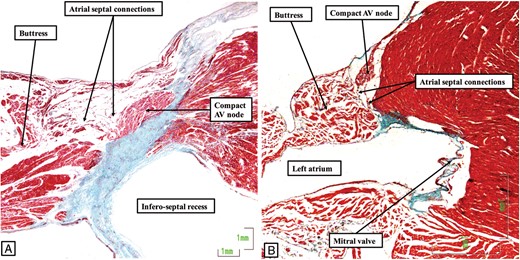 The images show how the conduction axis in both the human heart (A) and the murine heart (B) receive connections from the buttress of the atrial septum before penetrating to become the non-branching atrioventricular (AV) bundle. The image in (A) is from the same dataset as shown in Figure 3, while the image in (B) is from the dataset of the murine heart to be shown in Figure 5. In both datasets, the connections between the atrial septum and the axis are relatively tenuous. They are the final communication between the atrial walls and the axis before it becomes the penetrating component.