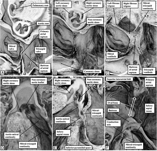 The images show the relationship between the base of the atrial septum and the infero-septal recess of the left ventricular outflow tract in the murine heart. All the images are taken from a three-dimensional dataset of a foetal mouse at embryonic cay E18.5, just prior to birth, and prepared using the technique of episcopic microscopy.15 (A) A view of the base of the heart as seen from the atrial aspect. (B) Is in the same plane, but cut closer to the atrioventricular junction, with (C) again in the same plane, but cut to show the buttress of the atrial septum. It is directly adjacent to the area of fibrous continuity between the leaflets of the mitral and tricuspid valves, which straddles the crest of the muscular ventricular septum. (D) A frontal view of the infero-septal recess of the left ventricle. It extends between the aortic leaflet of the mitral valve and the surface of the ventricular septum. (E) The ‘en face’ view of the septal surface, with the recess seen excavating beneath the area of mitral-to-tricuspid valvar continuity which provides the support for the buttress of the atrial septum. (F) Is a ‘four chamber’ cut. It shows the support provided to the buttress, and also demonstrates that the superior margin of the oval fossa, often described as the ‘septum secundum’, is an infolding of the atrial roof. The buttress is the true second atrial septum. As such, it is able to provide the input to the atrioventricular node via the atrial septal cardiomyocytes, as shown in Figure 4.