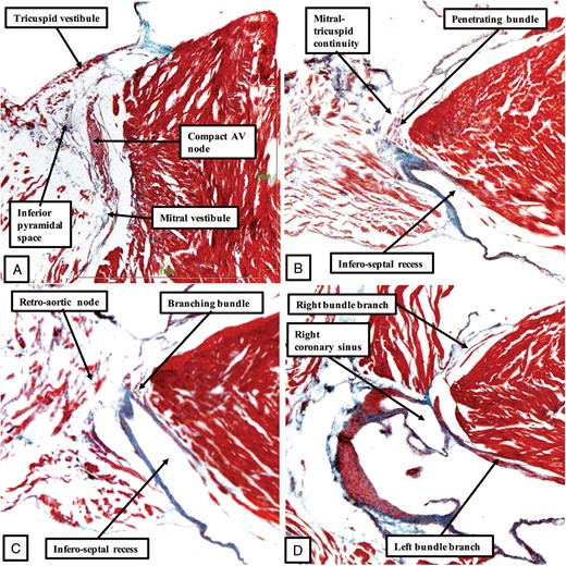 The images show the features of the conduction axis in the murine heart, prepared from a serially sectioned histological dataset, and presented in a fashion comparable to that used to produce Figure 3 for the human heart. As in the human heart, inferior extensions from the tricuspid and mitral vestibules come together at the apex of the inferior pyramidal space to form the compact atrioventricular (AV) node (A). As was shown in Figure 4B, and again as in the human heart (Figure 4A), the compact node in the murine heart receives connections from the buttress of the atrial septum before passing beneath the area of mitral-to-tricuspid valvar continuity to become the penetrating bundle (B). Replicating the situation in the human heart, this is a short non-branching component before the axis which gives off the fascicles of the left bundle branch (C). Again as in the human heart, the axis then gives off the right bundle branch on the crest of the muscular ventricular septum (D). Unlike the human heart, however, the murine heart does not have a membranous interventricular septum.