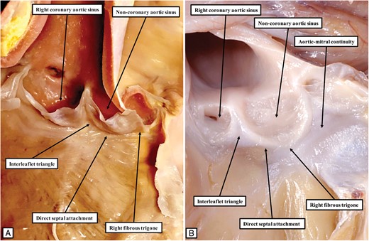 The image to the left hand (A) shows the typical arrangement of the aortic root in the canine heart. The ascending part of the hinge of the non-coronary leaflet, bordering the interleaflet triangle between the non-coronary and right coronary aortic valvar sinuses, is attached directly to the septal surface. In consequence of this feature, the rightward area of fibrous continuity between the leaflets of the aortic and mitral valves, known as the right fibrous trigone, is also attached directly to the septal surface. This is the exception rather than the rule in the human heart. The right fibrous trigone in the human heart is usually formed within the leftward margin of the infero-septal recess (Figure 2A). In some human hearts, however, the arrangement can parallel the situation as found in the canine heart, as shown in (B). Because of the direct attachment of the trigone to the septal surface, there is no formation of an infero-septal recess. The significance of this finding with regard to the arrangement of the conduction axis has yet to be established.