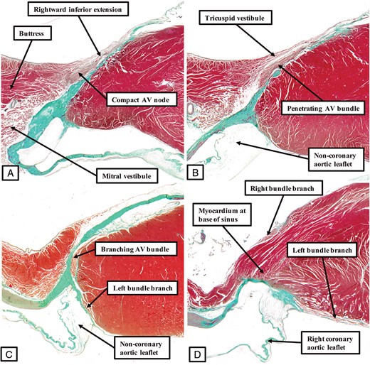 The panels, prepared in comparable fashion to the figures showing the arrangement of the axis in the human (Figure 3) and murine (Figure 5) hearts, show the features of the atrioventricular conduction axis as found in the canine heart. The compact atrioventricular node is formed from the rightward inferior extension at the site of attachment of the right fibrous trigone to the septal structure (A). The axis then becomes isolated from the atrial myocardium (B). As shown by Tawara, it then extends as a long non-branching bundle along the right side of the crest of the muscular ventricular septum (Figure 1A). It gives off the fascicles of the left bundle branch directly beneath the hinge of the non-coronary leaflet of the aortic valve (C) before branching to give of the right bundle branch, with the superior fascicle of the left bundle positioned directly beneath the hinge of the right coronary aortic valvar leaflet (D).