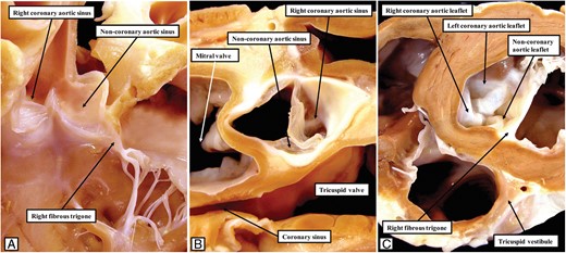 The images show the features of the left ventricular outflow tract in the porcine heart. As shown in (A), reflecting the arrangement in the canine heart (Figure 7A), the half of the non-coronary leaflet of the aortic valve adjacent to the right coronary sinus is attached, along with the right fibrous trigone, directly to the left surface of the septal structures. This is shown in (B), which is prepared by removing the non-coronary leaflet and showing the junction from the atrial aspect, and in (C), which shows the short axis of the junction from the ventricular aspect.