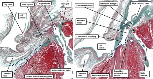 The images are serial sections taken from right to left through the septal component of a human foetal heart at 30 weeks’ gestation. In (A), the dotted lines show the inferior atrioventricular groove, which separates the basal surface of the atrial septum from the inferior component of the muscular ventricular septum. The groove, filled with fibroadipose tissue, extends superiorly to reach the inferior border of the atrioventricular node. In (B), the dotted lines show how the infero-septal recess of the subaortic outflow tract interposes between the leaflets of the mitral valve and the left ventricular aspect of the muscular ventricular septum. The branching part of the conduction axis is carried on the crest of the muscular septum (white star). The wall of the right ventricle directly cranial to the membranous part of the septum (black star) separates the ventricular cavity from the right atrioventricular groove. Note, in both panels, the location of the coronary sinus within the inferior atrioventricular groove. The sinus has its own myocardial walls, but strands of myocardium join the walls of the coronary sinus and the wall of the left atrium.