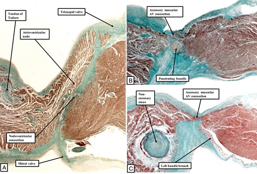The images show the atrioventricular conduction axis in the heart from an infant dying with tricuspid valvar dysplasia. (A) The atrioventricular (AV) node, with a small nodoventricular connection. (B, C) Two muscular atrioventricular connections that crossed over the area of the membranous septum.