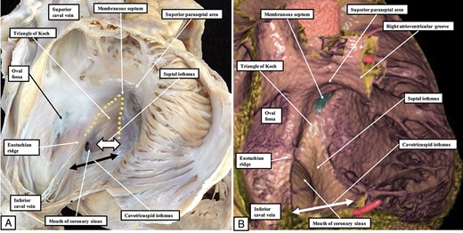 (A) The heart positioned in attitudinally appropriate position, with the right atrium opened by making a cut through the wall of the appendage, which has been reflected to show the septal surface and the annulus of the tricuspid valve. When the heart is positioned as it lies within the body, the apex of the triangle of Koch points superiorly. (B) A virtual dissection of a living dataset prepared by computed tomography. The superior paraseptal area is the atrial component of the supraventricular crest of the right ventricle. Note that the inferior paraseptal area, formed by the floor of the triangle of Koch, continues inferiorly as the septal isthmus, which is the part between the mouth of the coronary sinus and the hinge of the septal leaflet of the tricuspid valve. This area, in turn, is contiguous with the cavotricuspid isthmus, which then continues parietally as the inferior part of the right atrioventricular junction.