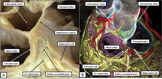 (A) A dissection made by removing the floor of the triangle of Koch, along with the non-coronary leaflet of the aortic valve. The apex of the inferior pyramidal space, which is filled with extracavitary fibro-adipose tissue, is adjacent superiorly to the inferior extent of the infero-septal recess of the left ventricle, with the fibrous base of the atrioventricular component of the membranous septum interposed between the two areas. (B) How the relationships are confirmed by virtual dissection of a computerised tomographic dataset. Note the course of the artery to the atrioventricular node through the inferior pyramidal space.