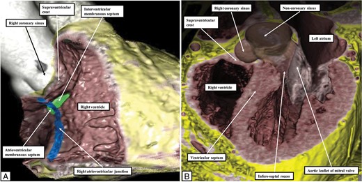 Virtual dissections of computed tomographic datasets show how the so-called ‘anterior septal area’, in reality the junction between the vestibule of the tricuspid valve and the supraventricular crest, is superior and paraseptal. It is directly adjacent to the right coronary sinus of the aortic root. (A) A cut across the inlet of the right ventricle, while (B) shows a frontal cut, emphasising that the supraventricular crest is directly related to the aortic root and hence is paraseptal rather than septal.