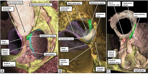 The images are virtual dissections of a computed tomographic dataset obtained from an individual undergoing assessment for suspected coronary arterial disease. They show the relationships of the sinuses of the aortic root to the adjacent structures. Panel A shows the view of the base of the ventricular mass as seen from above, and slightly from the right. In panel B, the larger part of the non-coronary sinus has been cut away to show the entrance to the infero-septal recess, which undermines the base of the atrial septum. Panel C then shows an oblique cut revealing the relationship of the triangle of Koch, containing the regular atrioventricular node towards its apex, to the site of the retro-aortic node, found in the base of the atrial septum.